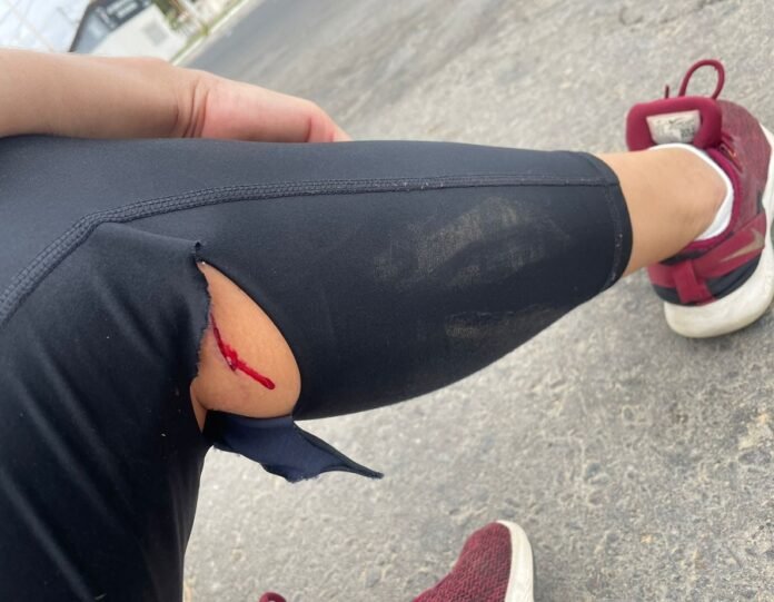 Mais um ataque de cachorro na Orla de Petrolina (PE); Vítima faz alerta aos pais com suas crianças